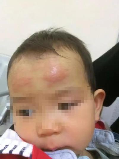 女婴用网红款退热贴后红肿流脓!退热贴有用吗?